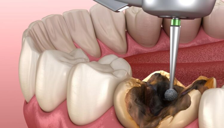 عکس استوک دندان و دندان پزشکی سه بعدی   Treatment of tooth 3d