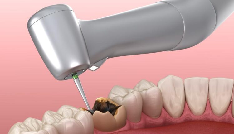 عکس استوک دندان و دندان پزشکی سه بعدی   Treatment of tooth 3d