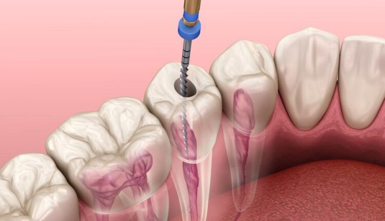 عکس استوک دندان و دندان پزشکی سه بعدی   Treatment of tooth 3d