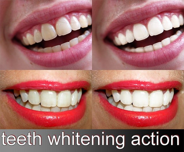 دانلود اکشن سفیدکننده دندان Teeth White